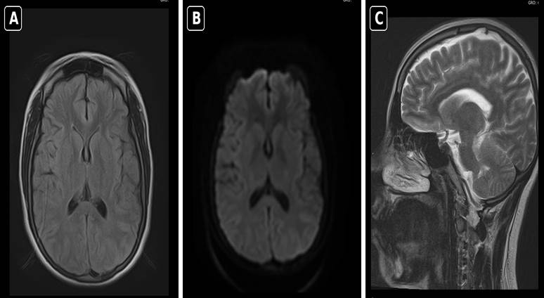 Figura 1. Resonancia magnética cerebral del 29 de agosto de 2024. A) Secuencia axial FLAIR (recuperación de inversión con supresión de líquido). B) Difusión axial. C) Secuencia sagital T2. Cortes seleccionados del estudio cuyo informe no describió lesión estructural aguda.
